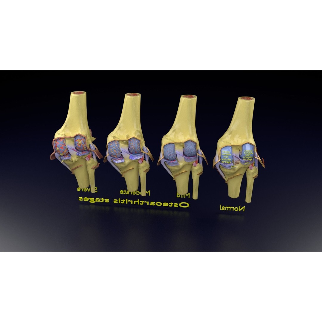 Osteoarthritis 3D Model – Medical Anatomy with Detailed Staging - View 143