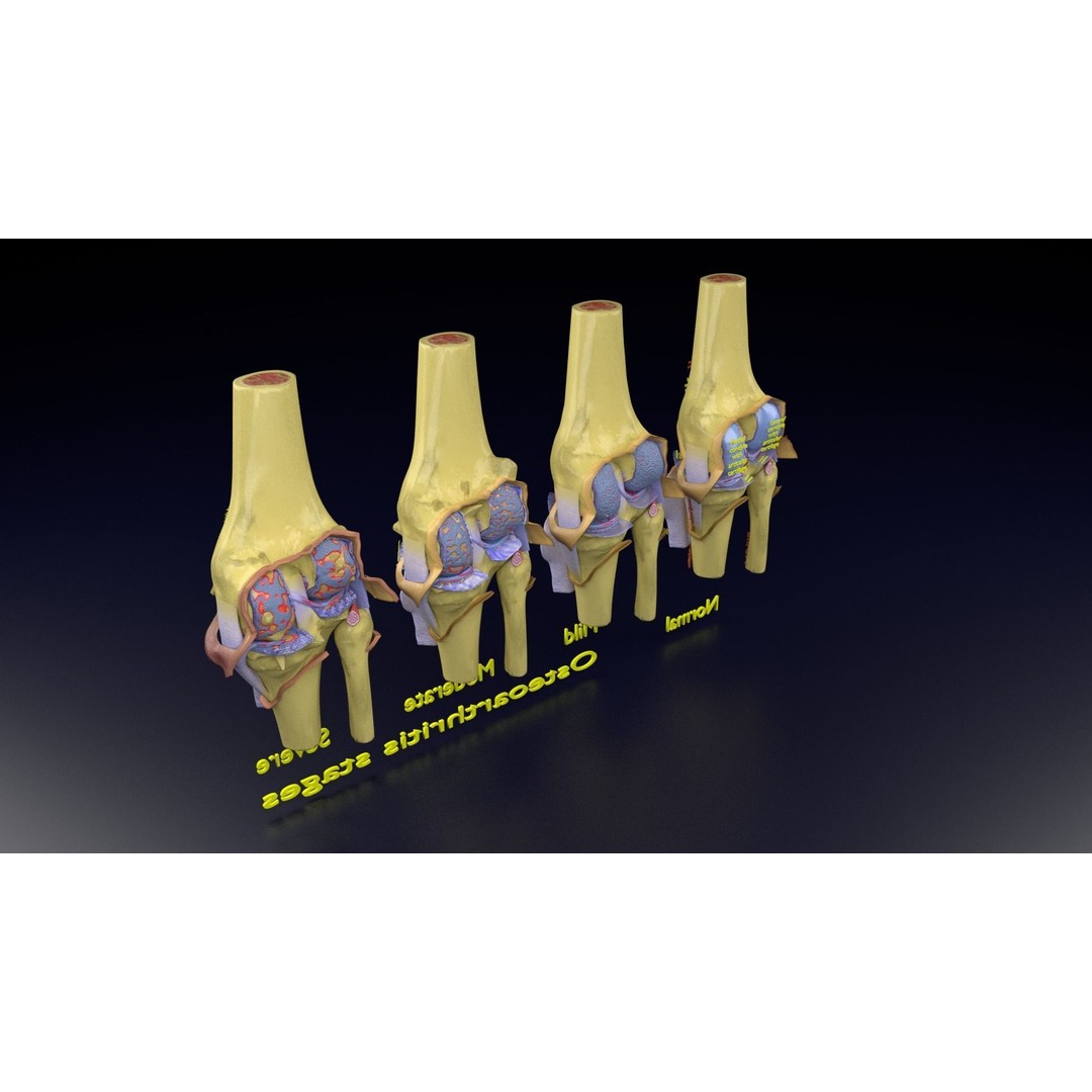 Osteoarthritis 3D Model – Medical Anatomy with Detailed Staging - View 145