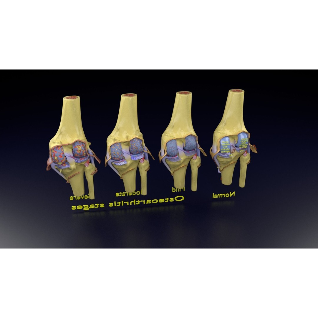 Osteoarthritis 3D Model – Medical Anatomy with Detailed Staging - View 146