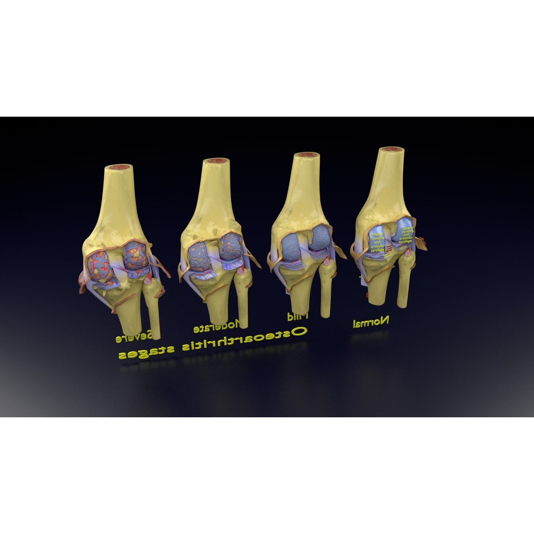 Osteoarthritis 3D Model – Medical Anatomy with Detailed Staging - View 147