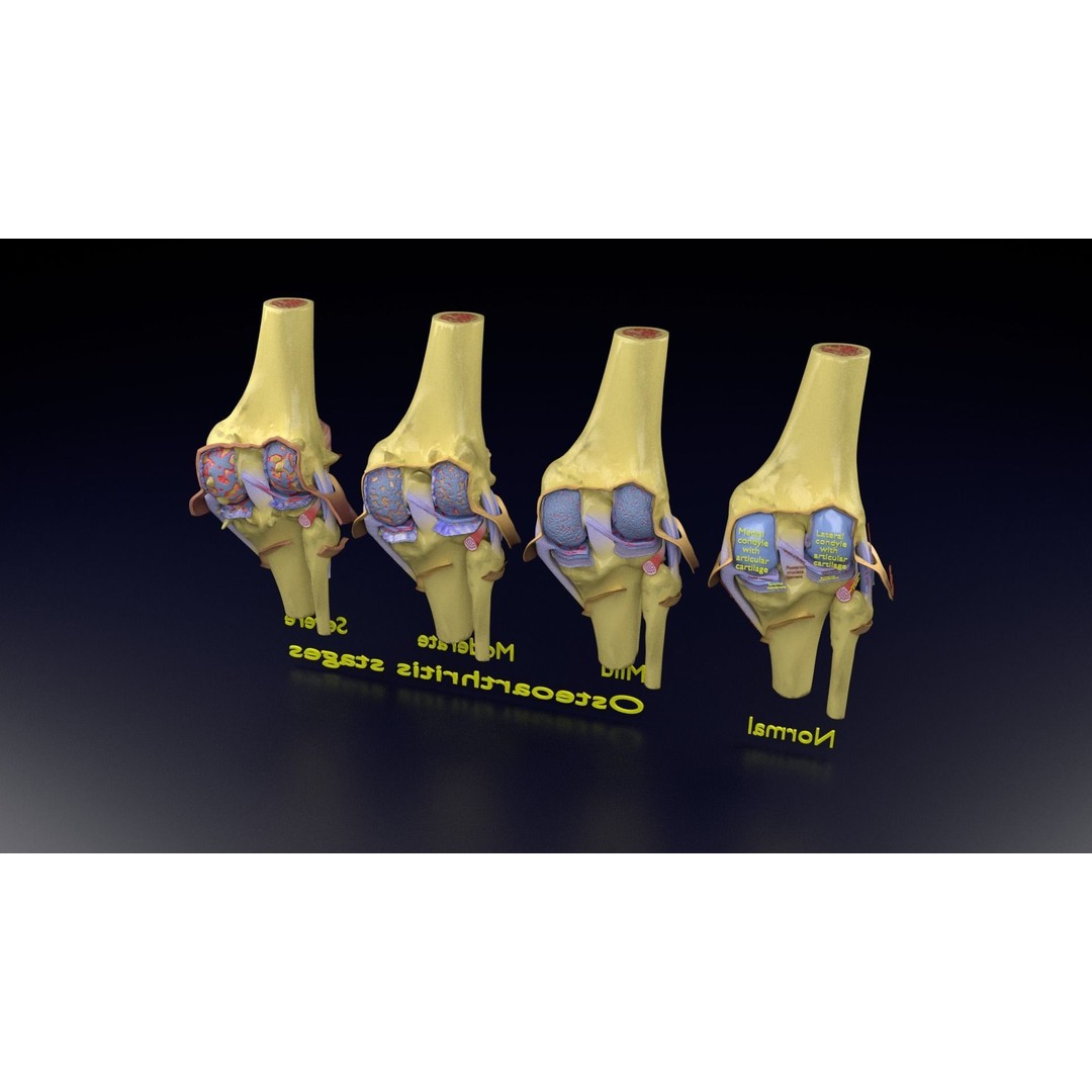 Osteoarthritis 3D Model – Medical Anatomy with Detailed Staging - View 148
