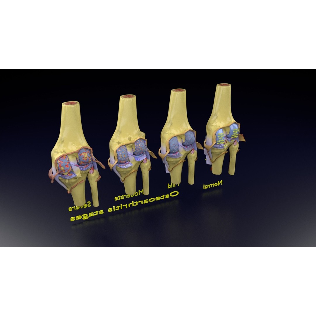 Osteoarthritis 3D Model – Medical Anatomy with Detailed Staging - View 149