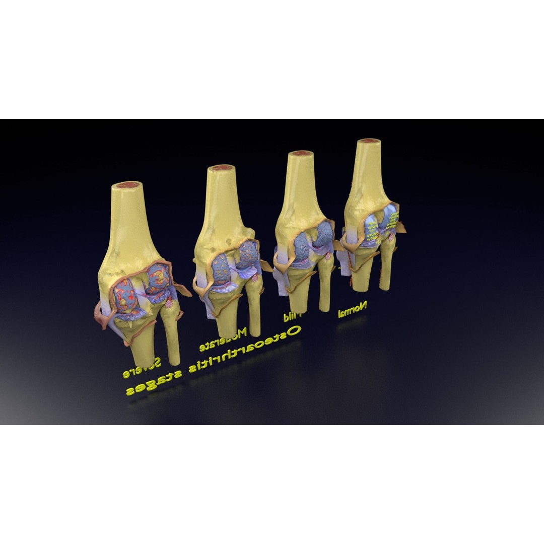 Osteoarthritis 3D Model – Medical Anatomy with Detailed Staging - View 150