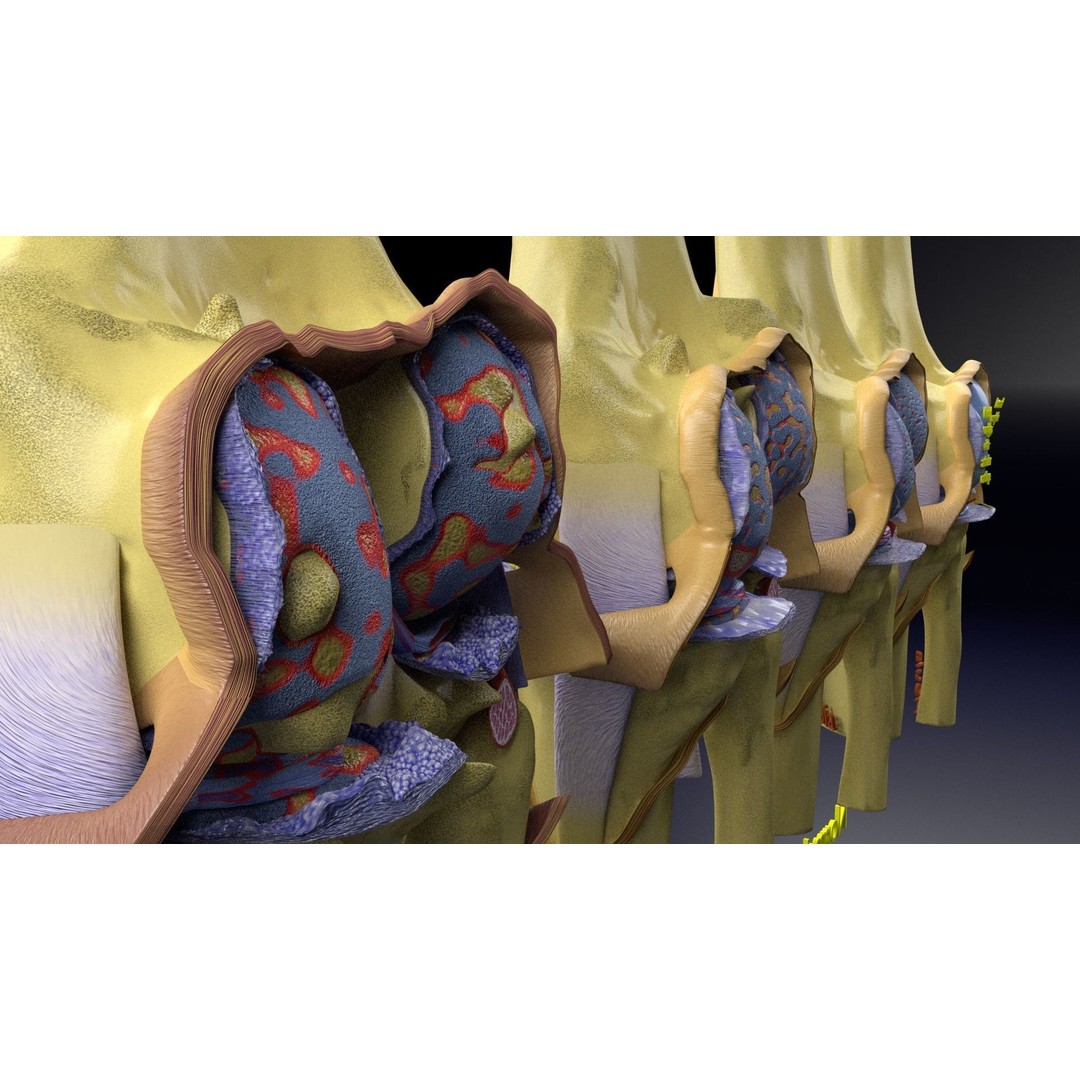 Osteoarthritis 3D Model – Medical Anatomy with Detailed Staging - View 17
