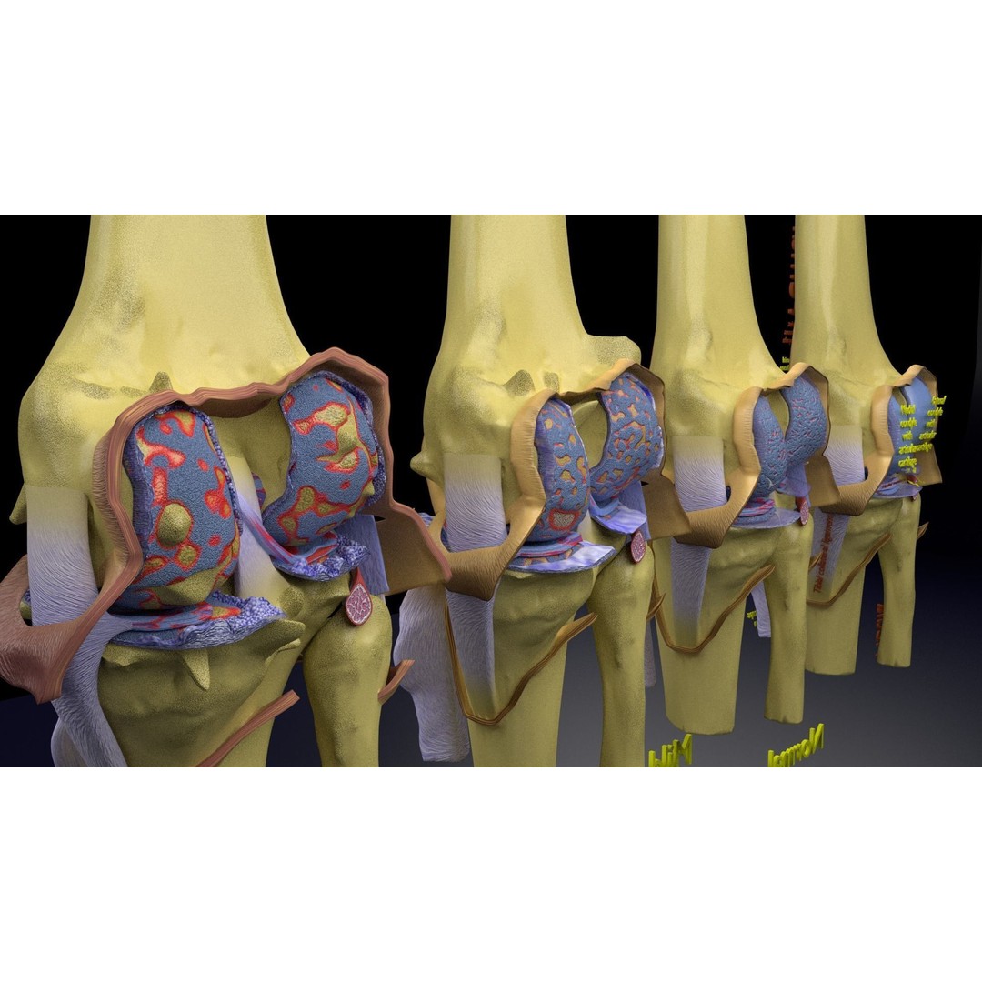Osteoarthritis 3D Model – Medical Anatomy with Detailed Staging - View 18