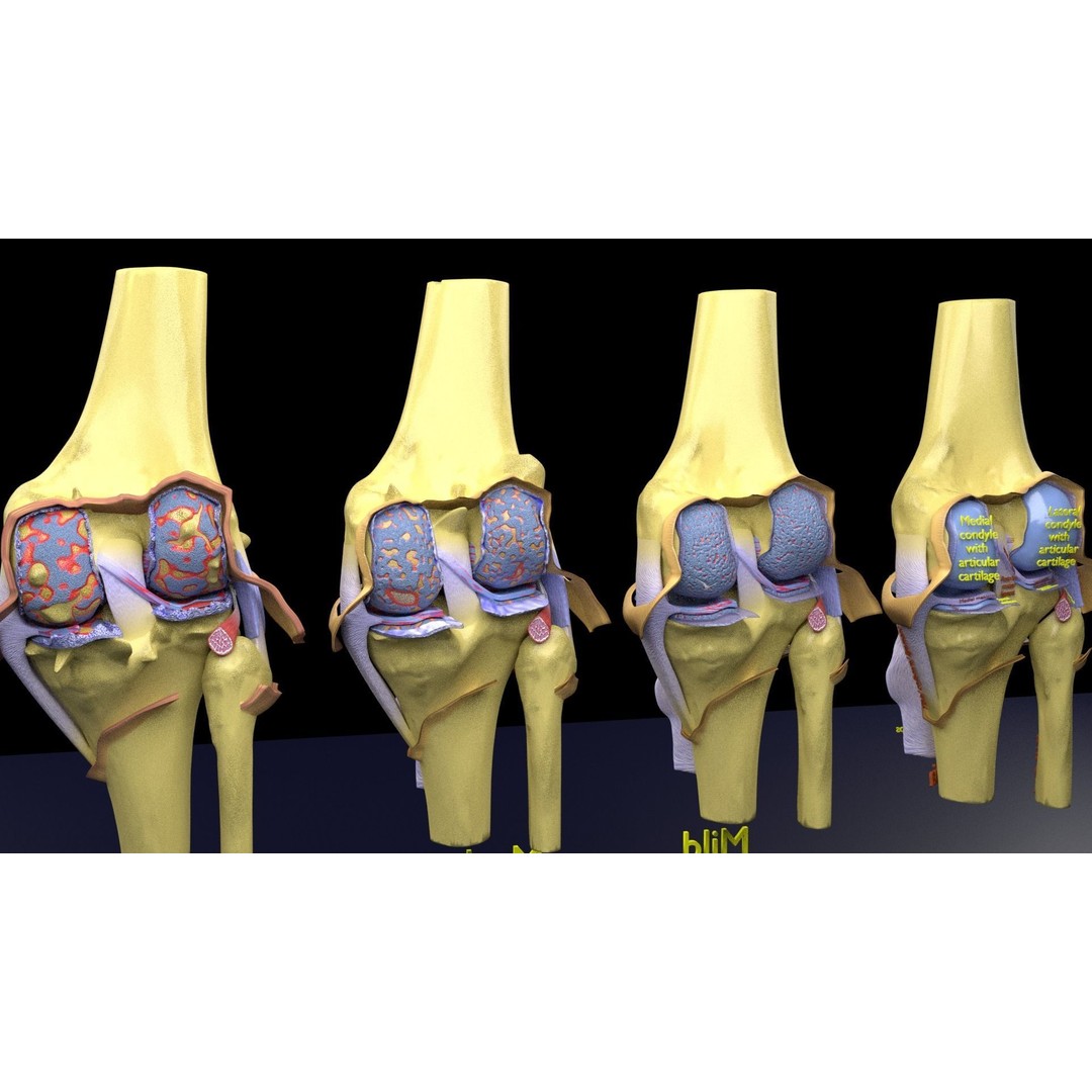 Osteoarthritis 3D Model – Medical Anatomy with Detailed Staging - View 19