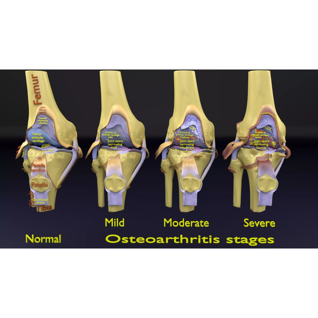 Osteoarthritis 3D Model – Medical Anatomy with Detailed Staging - View 2