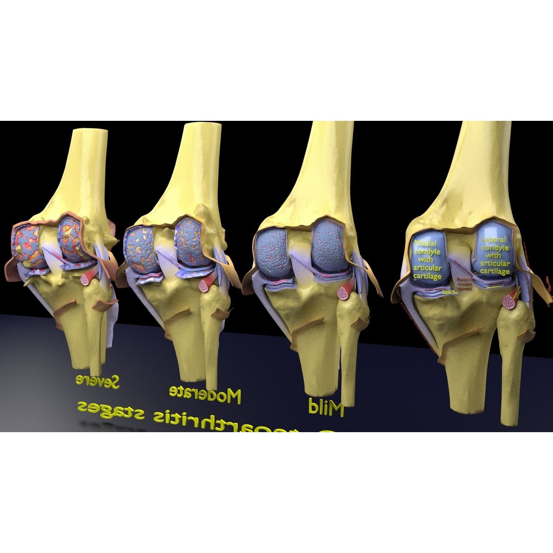 Osteoarthritis 3D Model – Medical Anatomy with Detailed Staging - View 20