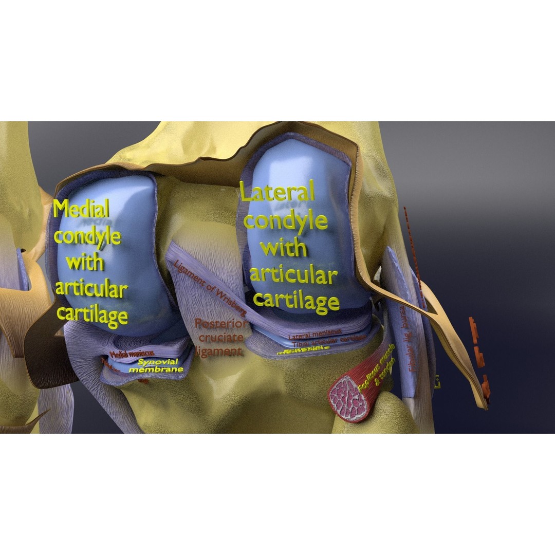 Osteoarthritis 3D Model – Medical Anatomy with Detailed Staging - View 21