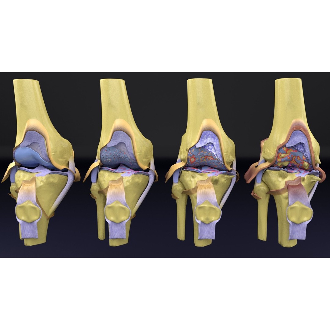 Osteoarthritis 3D Model – Medical Anatomy with Detailed Staging - View 22