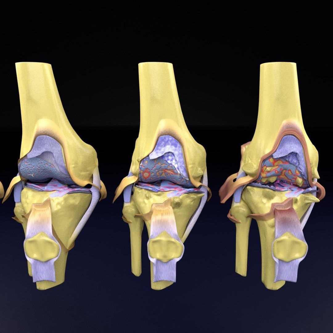 Osteoarthritis 3D Model – Medical Anatomy with Detailed Staging - View 23
