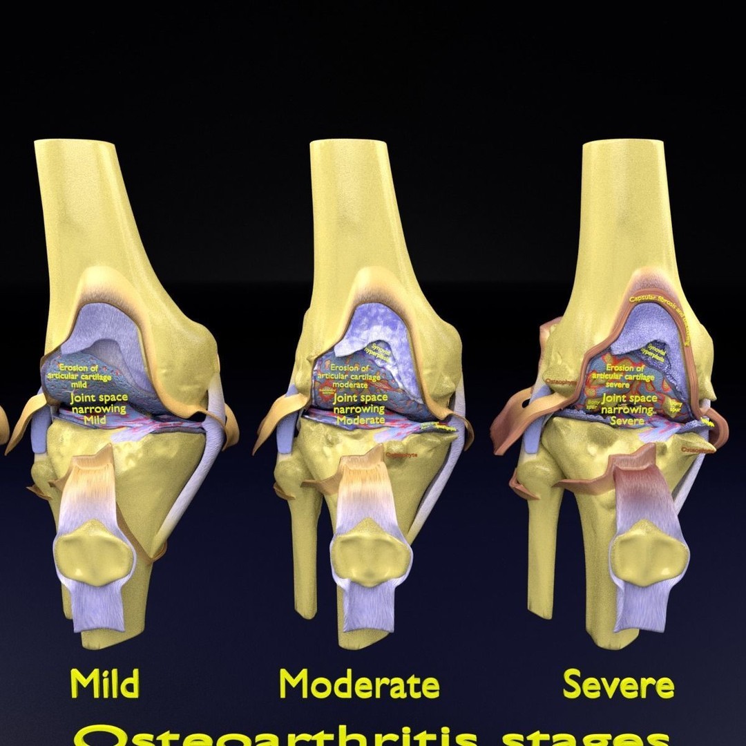 Osteoarthritis 3D Model – Medical Anatomy with Detailed Staging - View 24