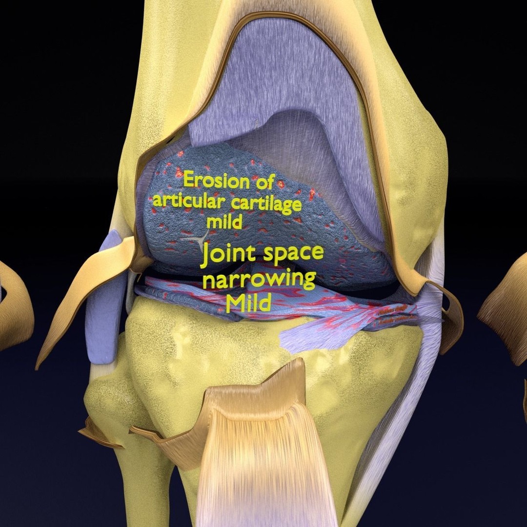 Osteoarthritis 3D Model – Medical Anatomy with Detailed Staging - View 26