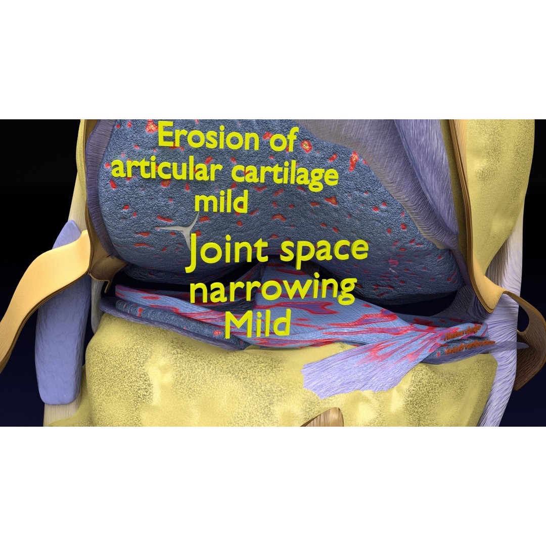 Osteoarthritis 3D Model – Medical Anatomy with Detailed Staging - View 27
