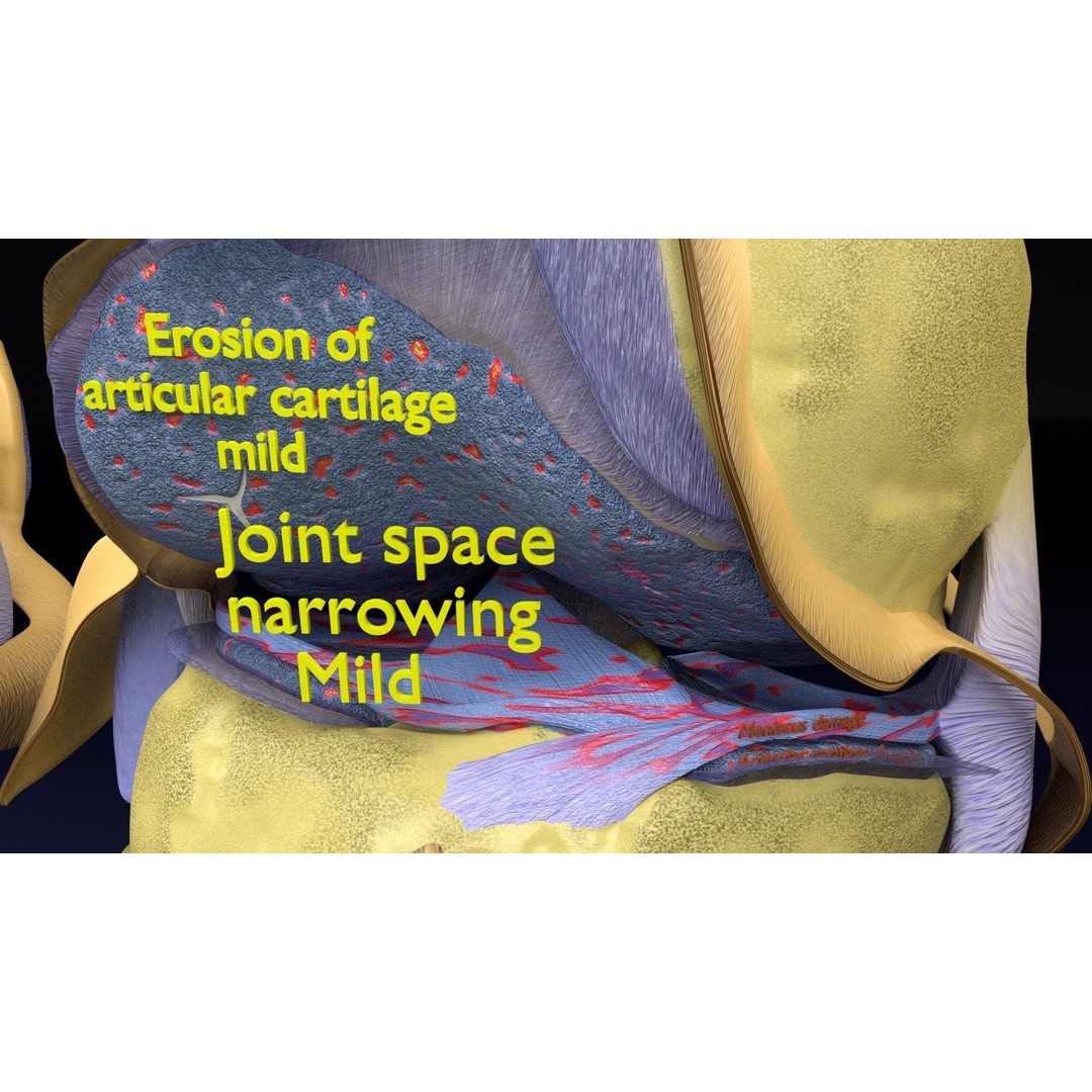 Osteoarthritis 3D Model – Medical Anatomy with Detailed Staging - View 28