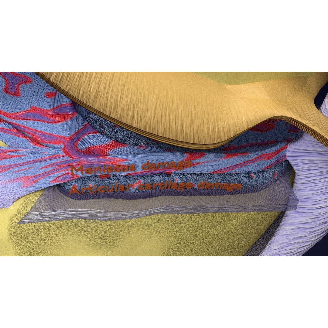 Osteoarthritis 3D Model – Medical Anatomy with Detailed Staging - View 29