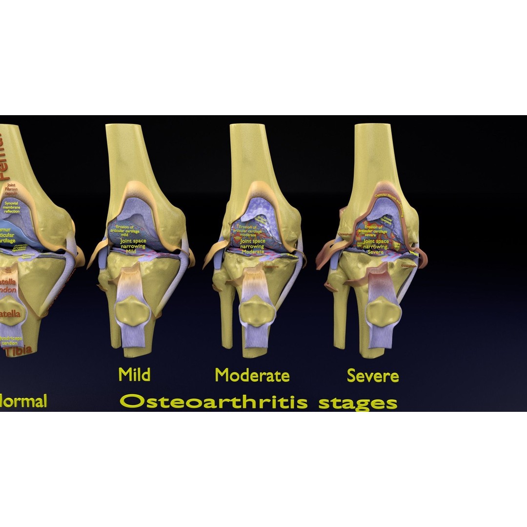 Osteoarthritis 3D Model – Medical Anatomy with Detailed Staging - View 3