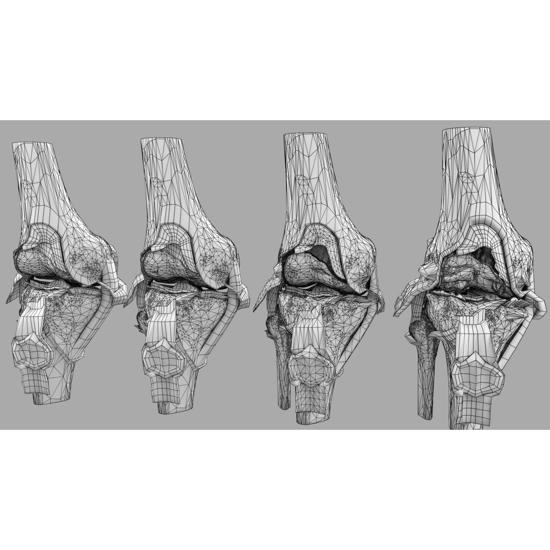 Osteoarthritis 3D Model – Medical Anatomy with Detailed Staging - View 30