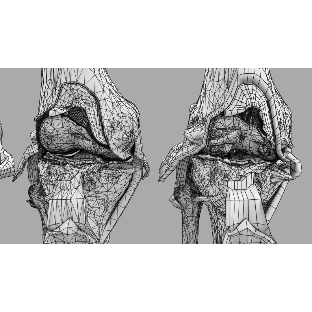 Osteoarthritis 3D Model – Medical Anatomy with Detailed Staging - View 31