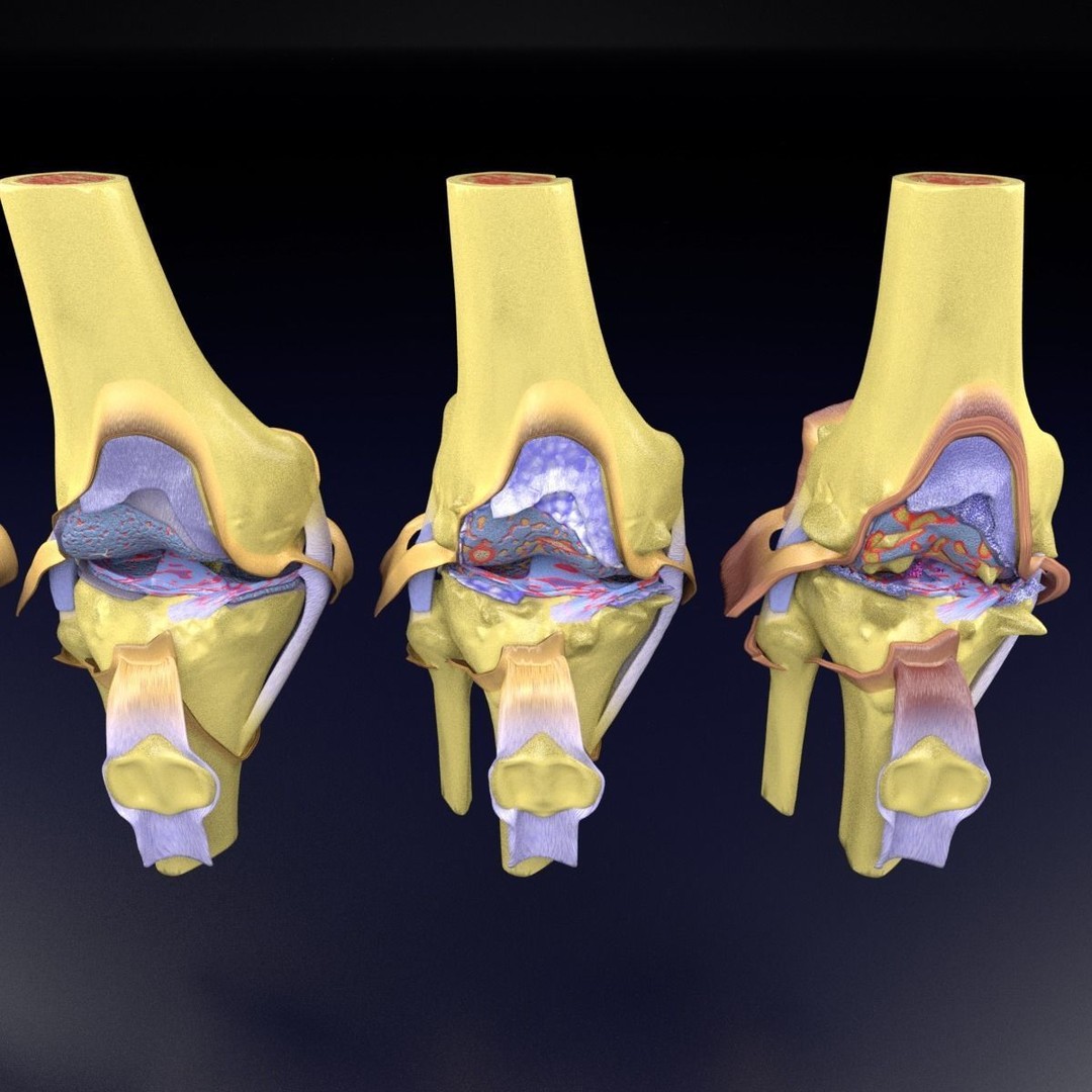 Osteoarthritis 3D Model – Medical Anatomy with Detailed Staging - View 32