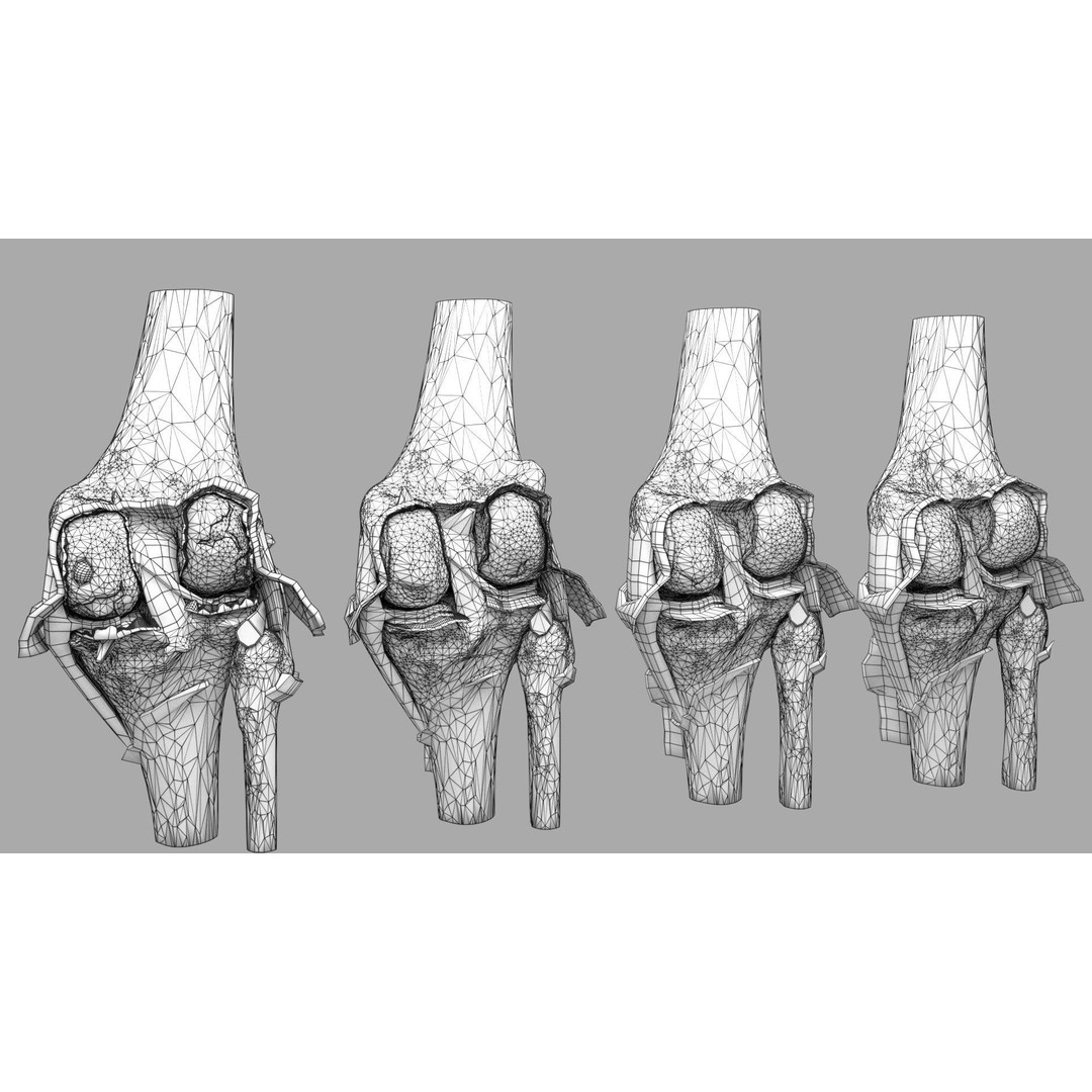 Osteoarthritis 3D Model – Medical Anatomy with Detailed Staging - View 33