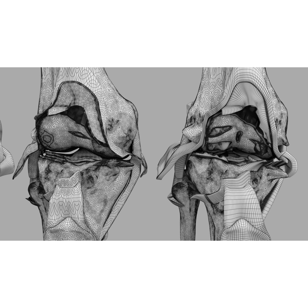 Osteoarthritis 3D Model – Medical Anatomy with Detailed Staging - View 34