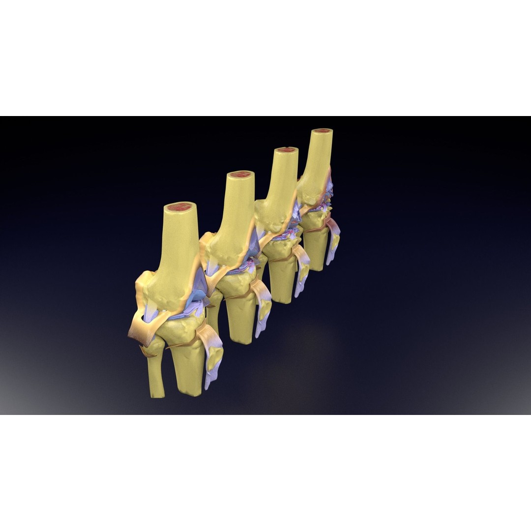 Osteoarthritis 3D Model – Medical Anatomy with Detailed Staging - View 36