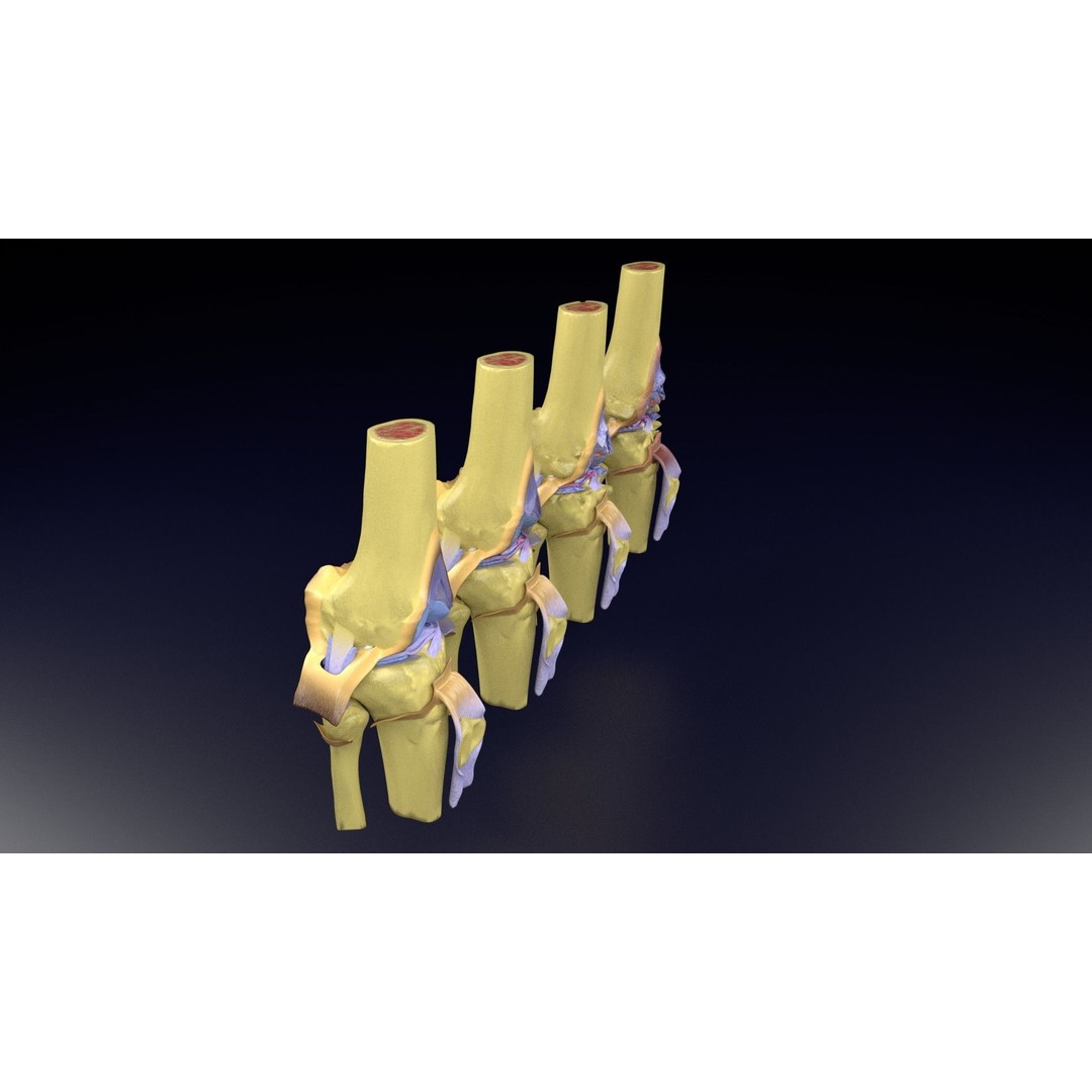 Osteoarthritis 3D Model – Medical Anatomy with Detailed Staging - View 37