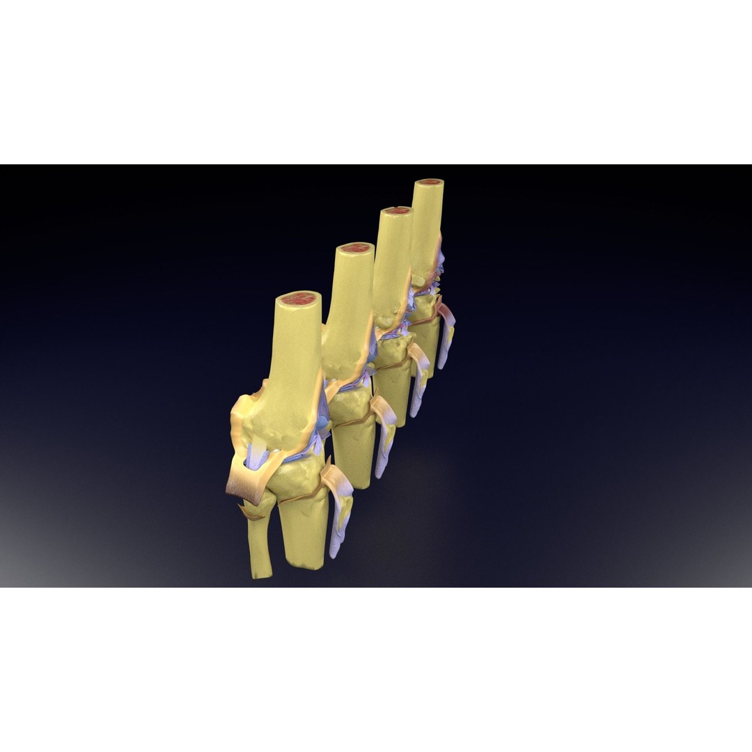 Osteoarthritis 3D Model – Medical Anatomy with Detailed Staging - View 38