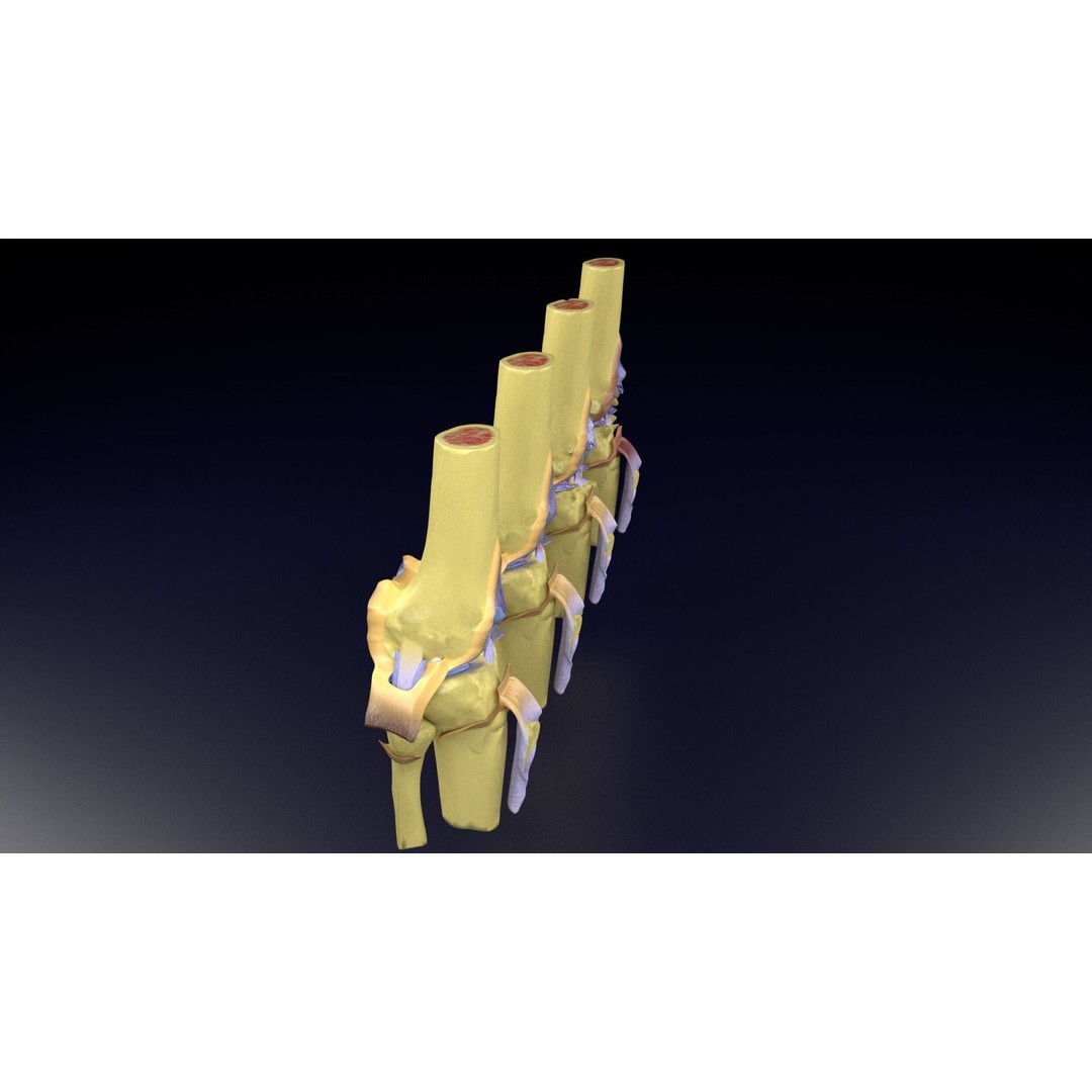 Osteoarthritis 3D Model – Medical Anatomy with Detailed Staging - View 39