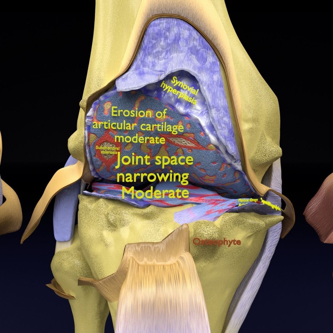 Osteoarthritis 3D Model – Medical Anatomy with Detailed Staging - View 4