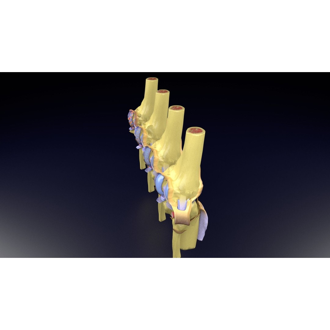 Osteoarthritis 3D Model – Medical Anatomy with Detailed Staging - View 42