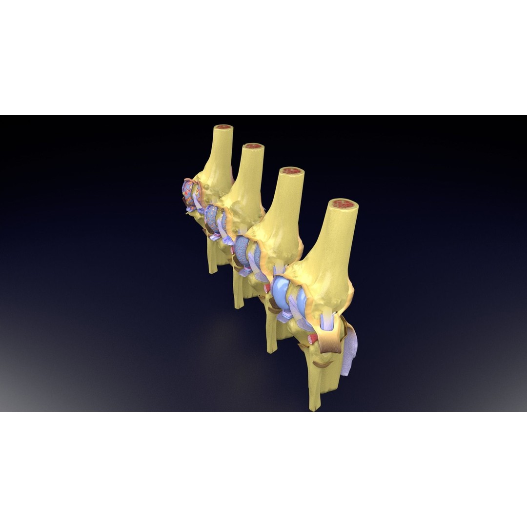 Osteoarthritis 3D Model – Medical Anatomy with Detailed Staging - View 43