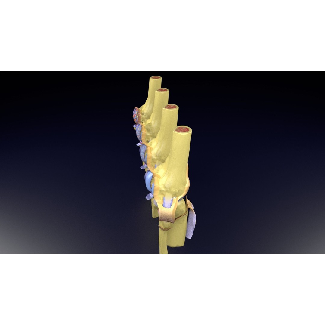 Osteoarthritis 3D Model – Medical Anatomy with Detailed Staging - View 45