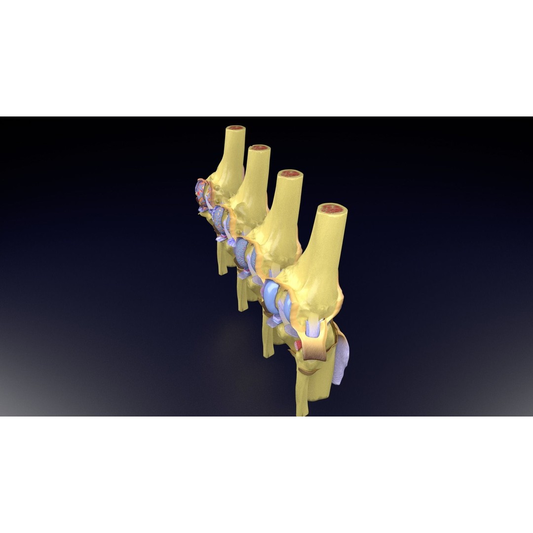 Osteoarthritis 3D Model – Medical Anatomy with Detailed Staging - View 46