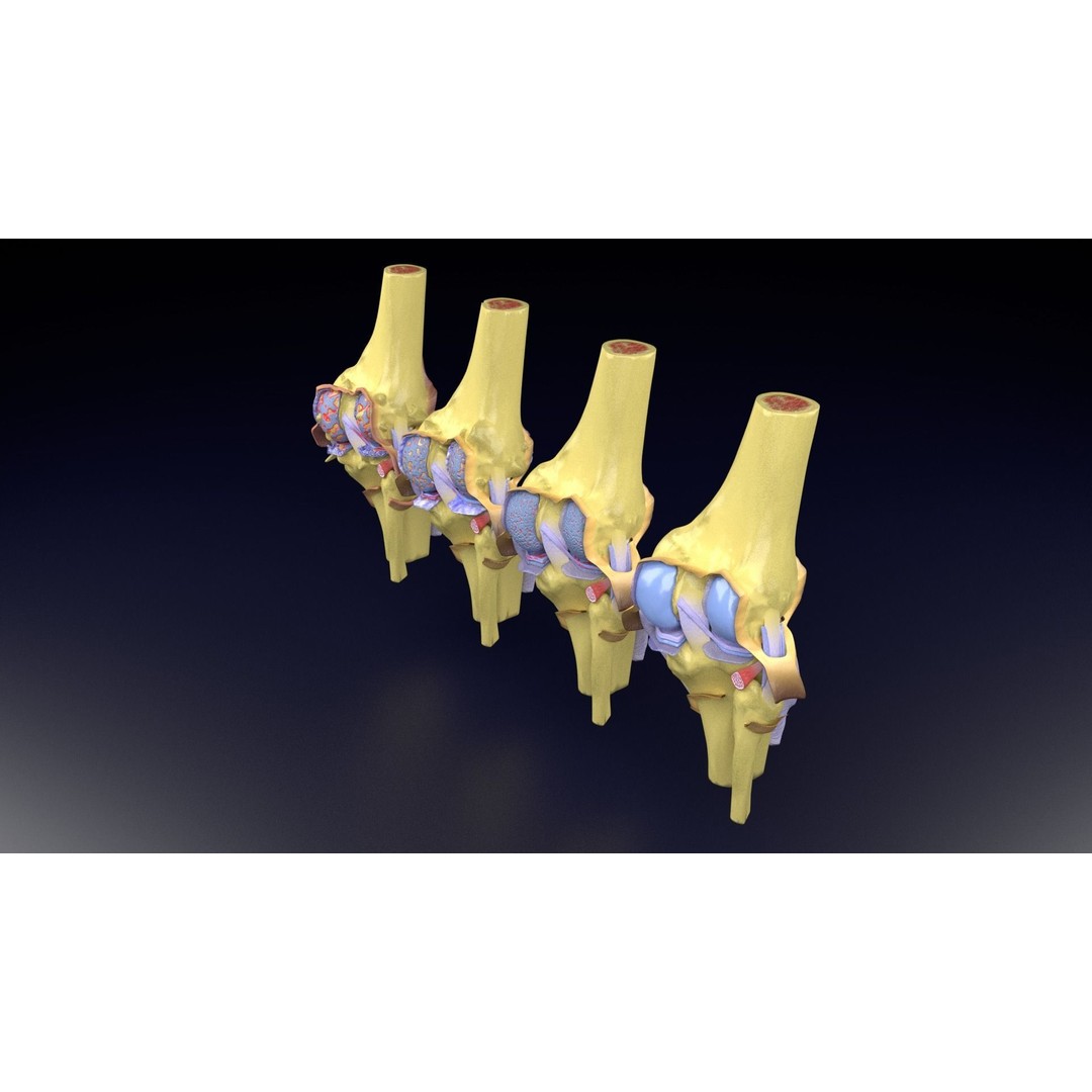 Osteoarthritis 3D Model – Medical Anatomy with Detailed Staging - View 48