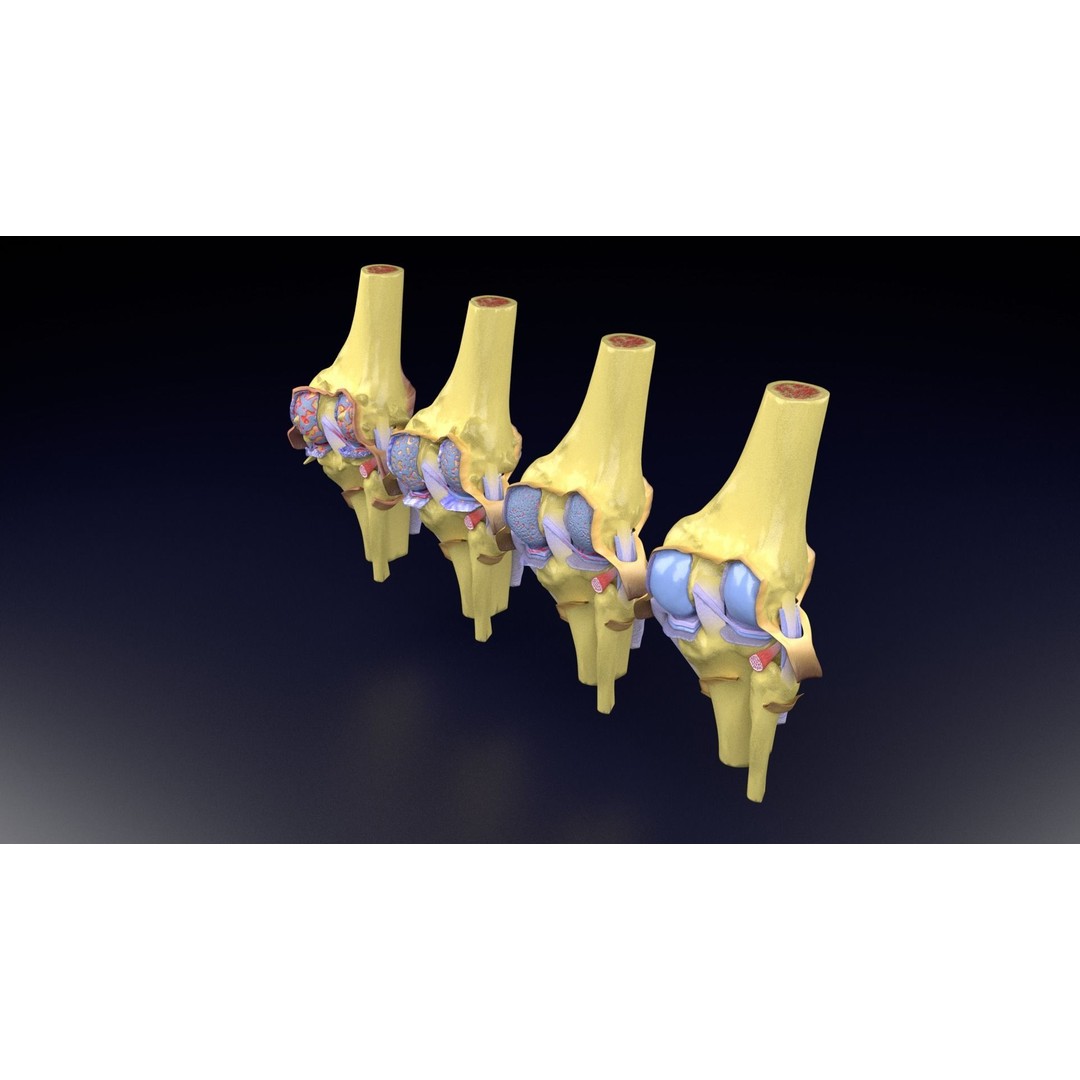 Osteoarthritis 3D Model – Medical Anatomy with Detailed Staging - View 49