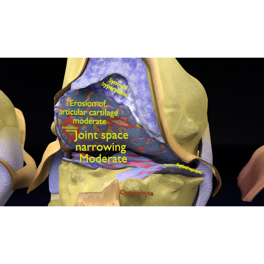Osteoarthritis 3D Model – Medical Anatomy with Detailed Staging - View 5