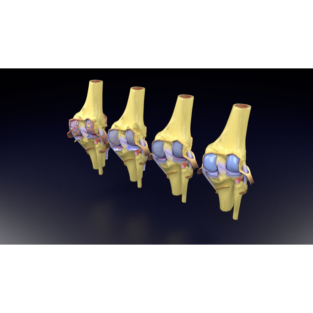 Osteoarthritis 3D Model – Medical Anatomy with Detailed Staging - View 50