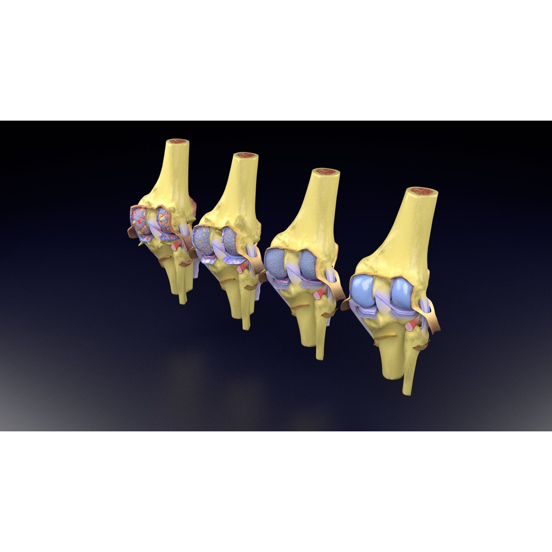 Osteoarthritis 3D Model – Medical Anatomy with Detailed Staging - View 51