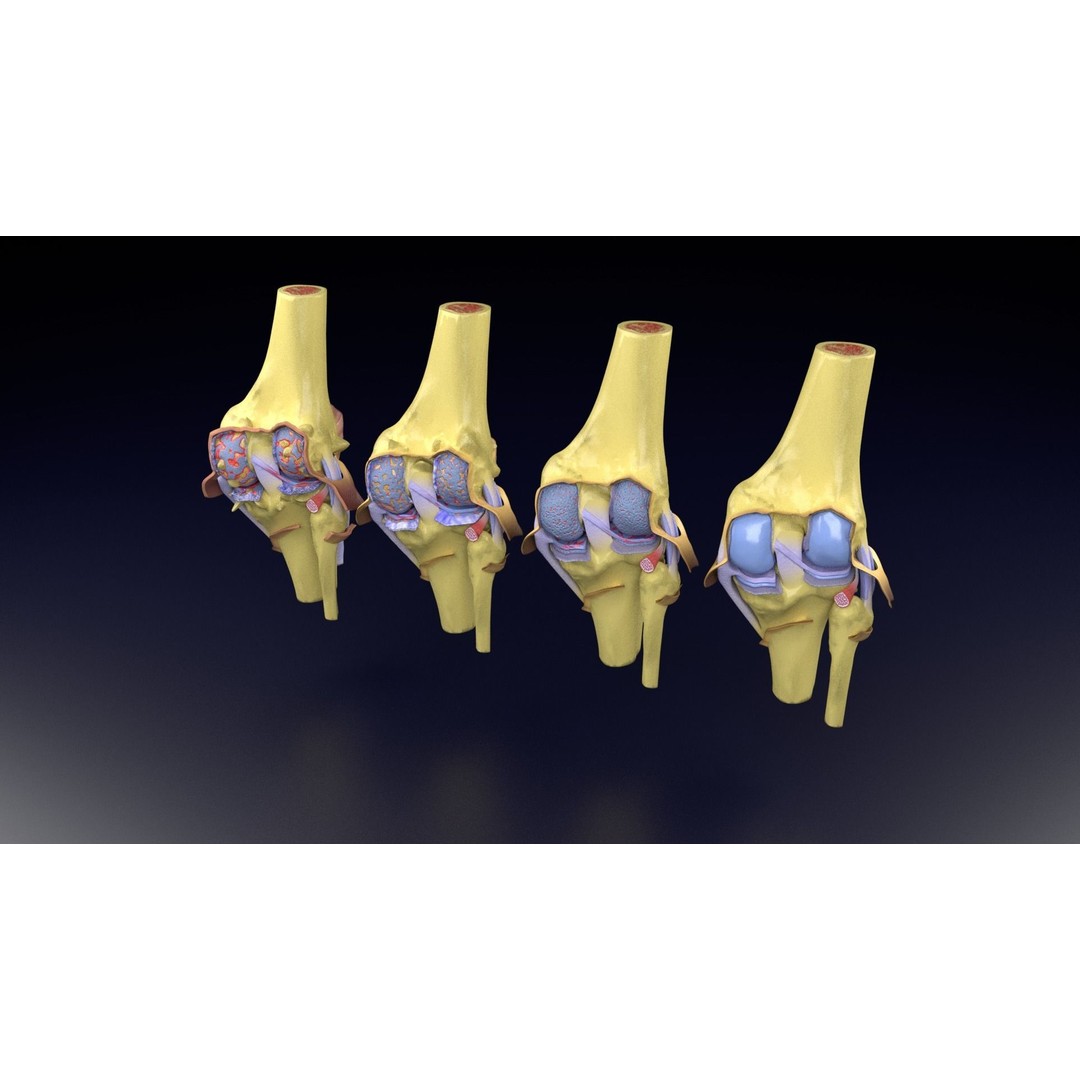 Osteoarthritis 3D Model – Medical Anatomy with Detailed Staging - View 52