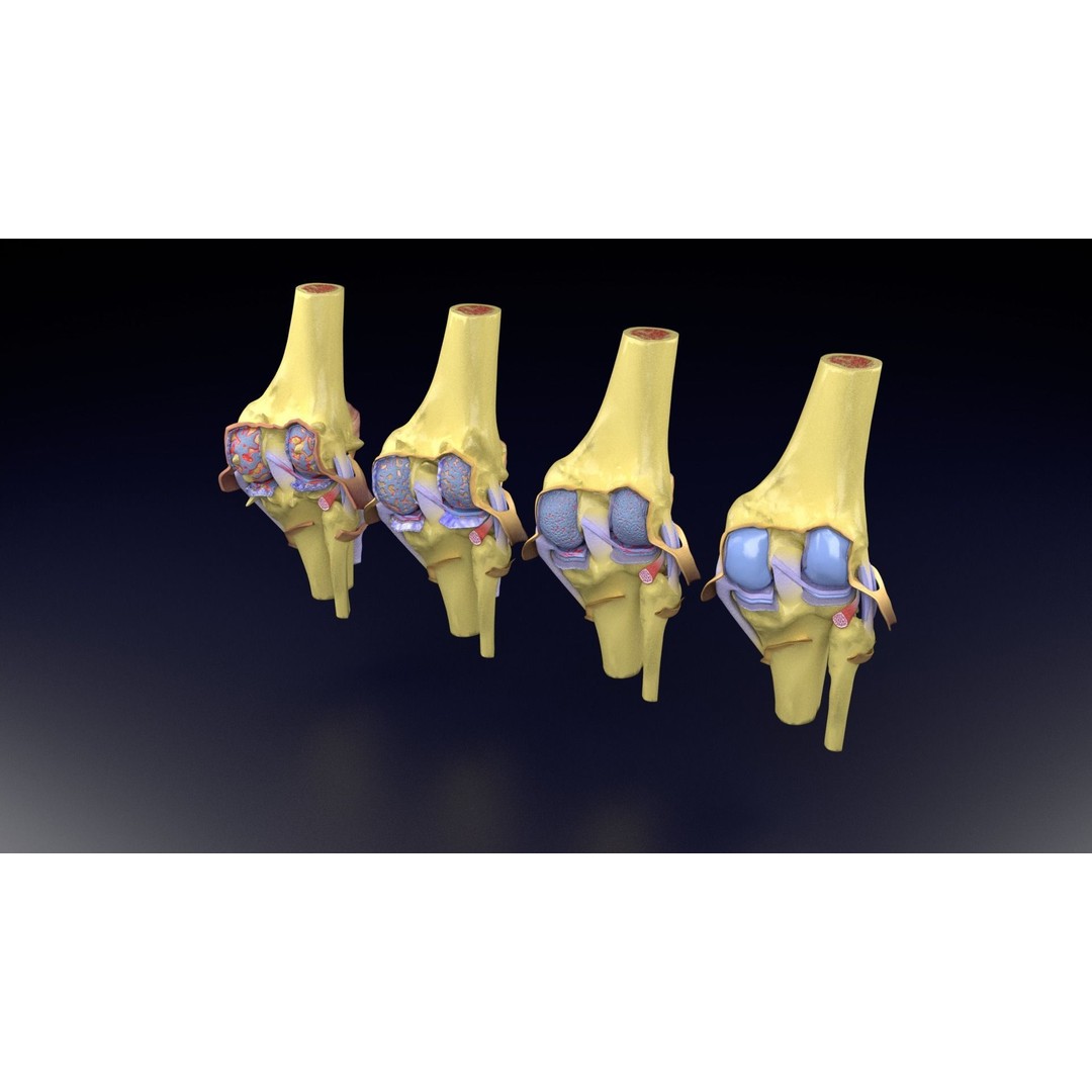 Osteoarthritis 3D Model – Medical Anatomy with Detailed Staging - View 53