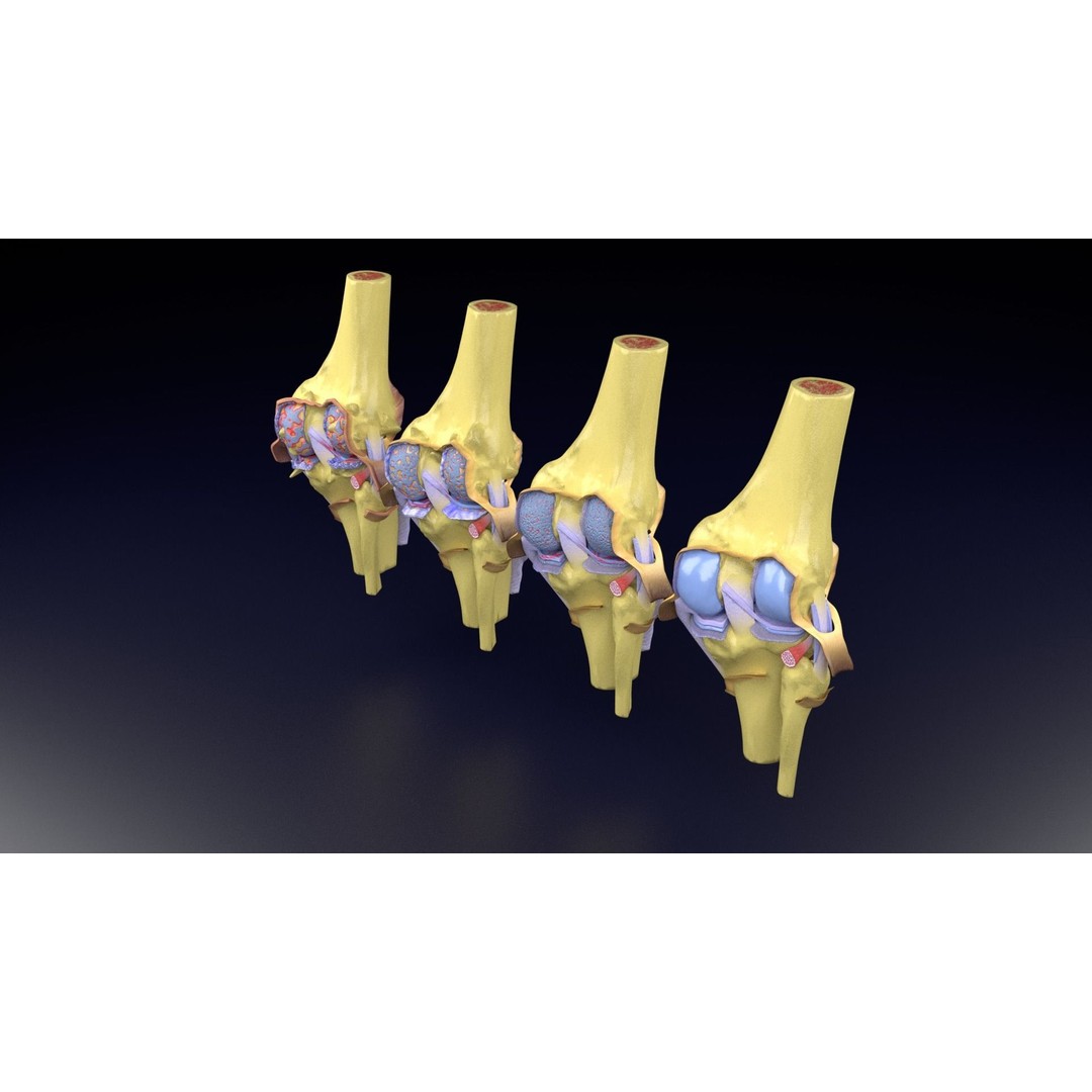 Osteoarthritis 3D Model – Medical Anatomy with Detailed Staging - View 54