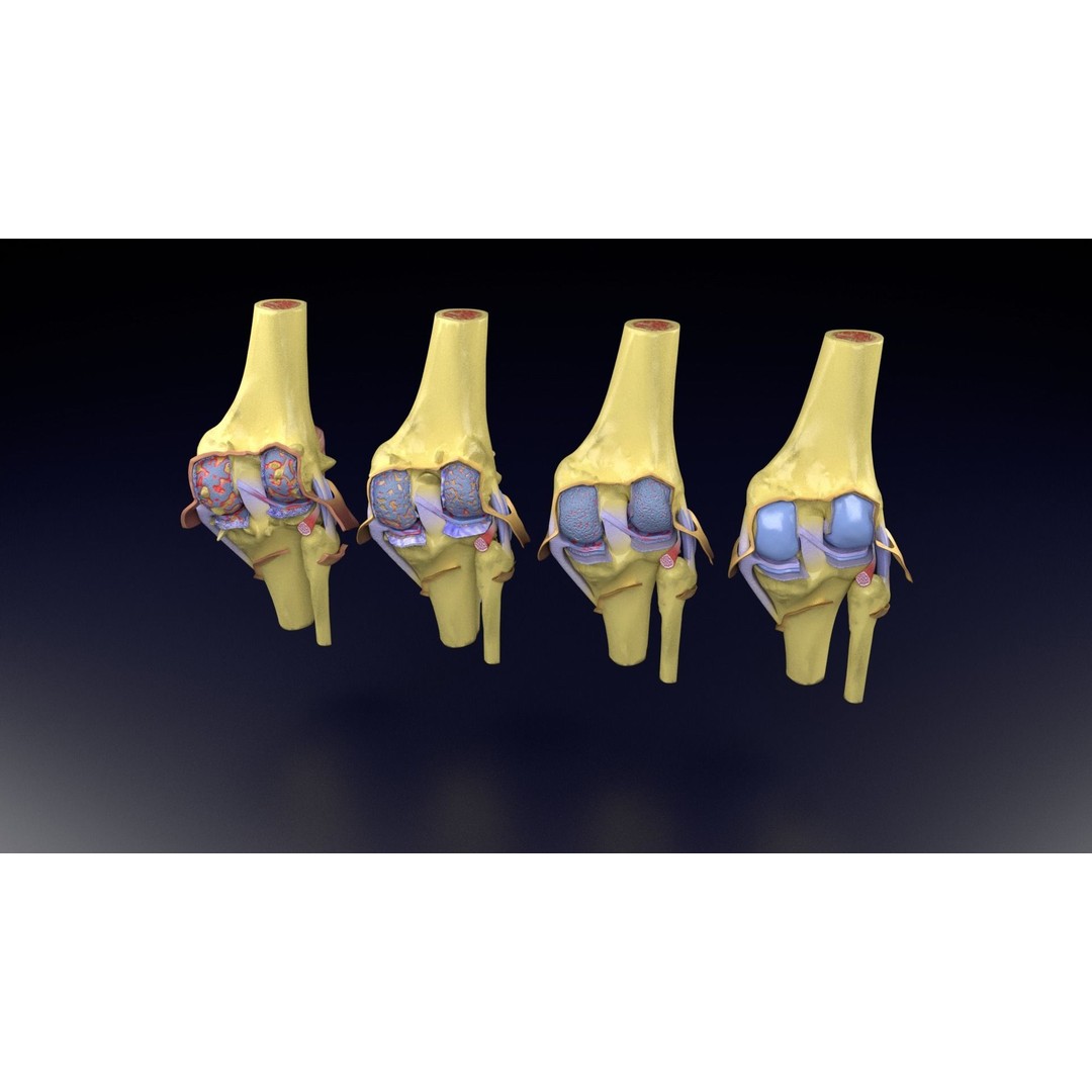 Osteoarthritis 3D Model – Medical Anatomy with Detailed Staging - View 55