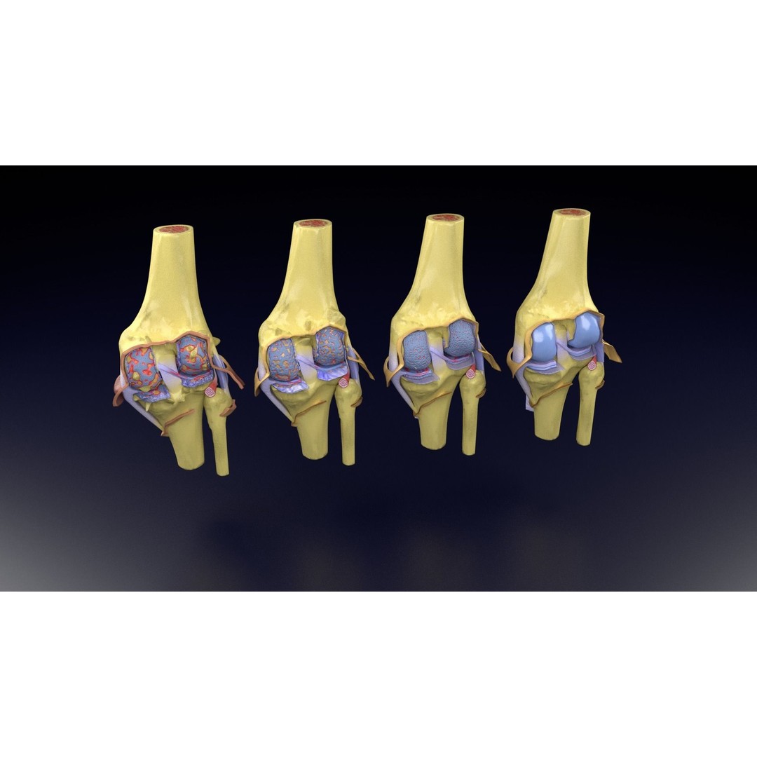 Osteoarthritis 3D Model – Medical Anatomy with Detailed Staging - View 56