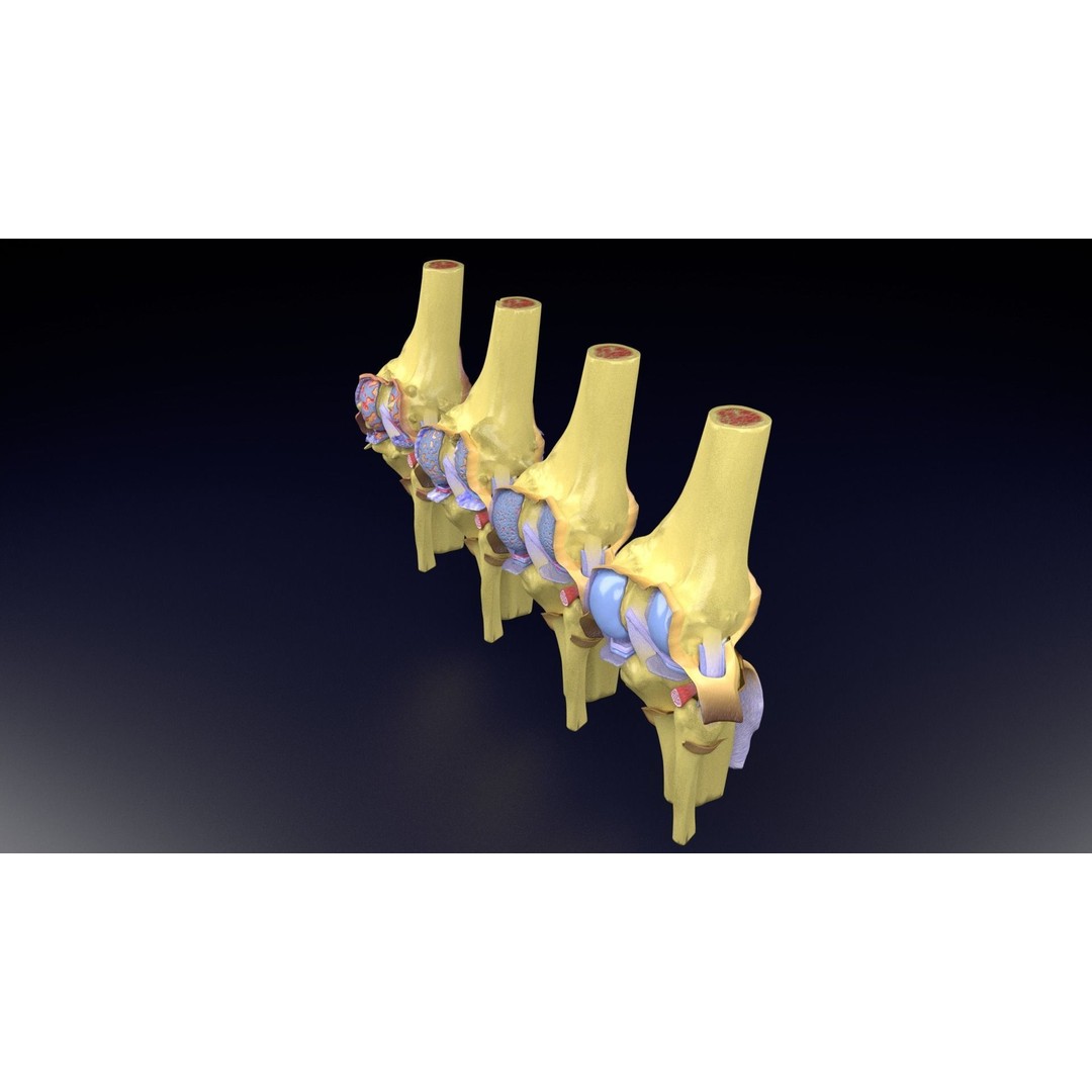 Osteoarthritis 3D Model – Medical Anatomy with Detailed Staging - View 57