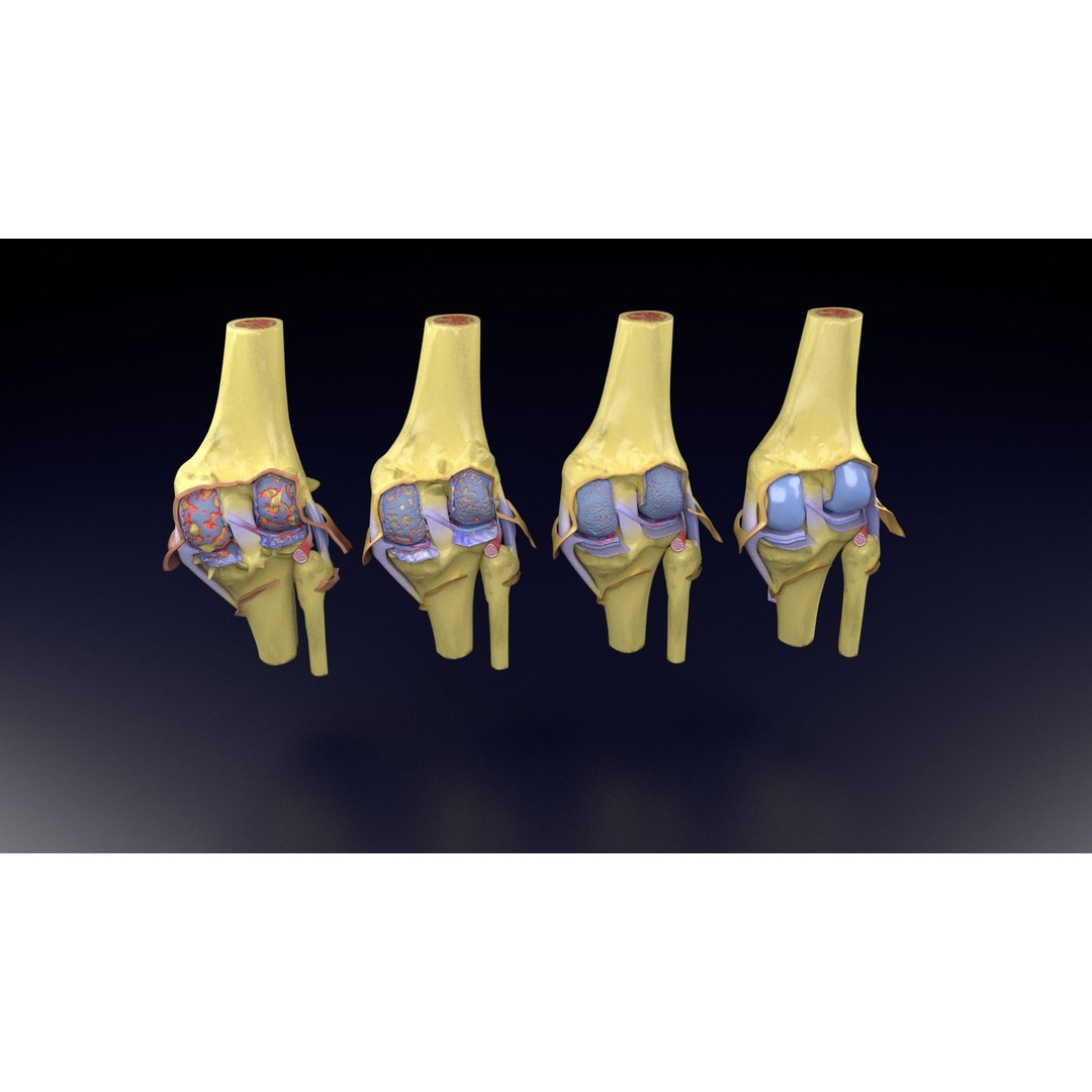 Osteoarthritis 3D Model – Medical Anatomy with Detailed Staging - View 58