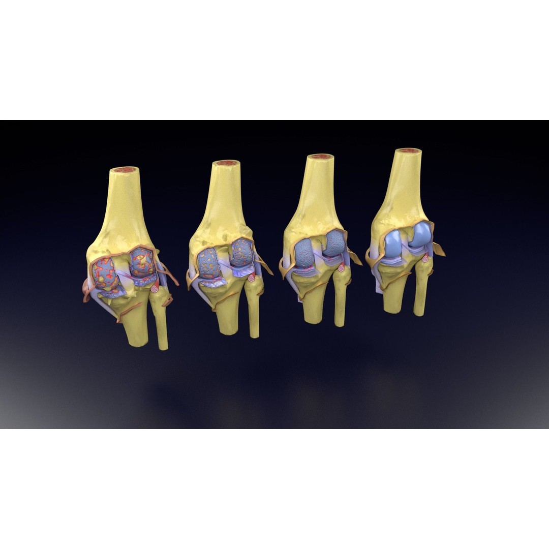 Osteoarthritis 3D Model – Medical Anatomy with Detailed Staging - View 59