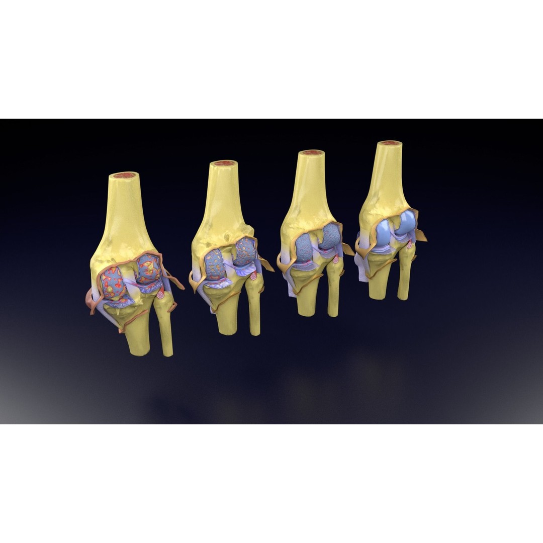 Osteoarthritis 3D Model – Medical Anatomy with Detailed Staging - View 60