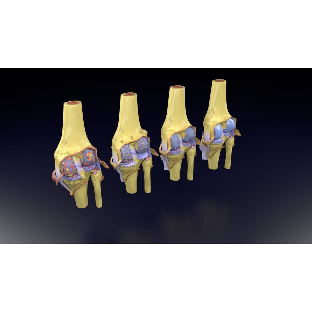 Osteoarthritis 3D Model – Medical Anatomy with Detailed Staging - View 61